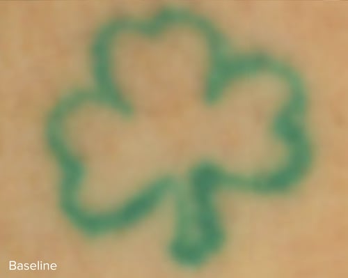 Baseline Colour Laser Tattoo Removal Treatment