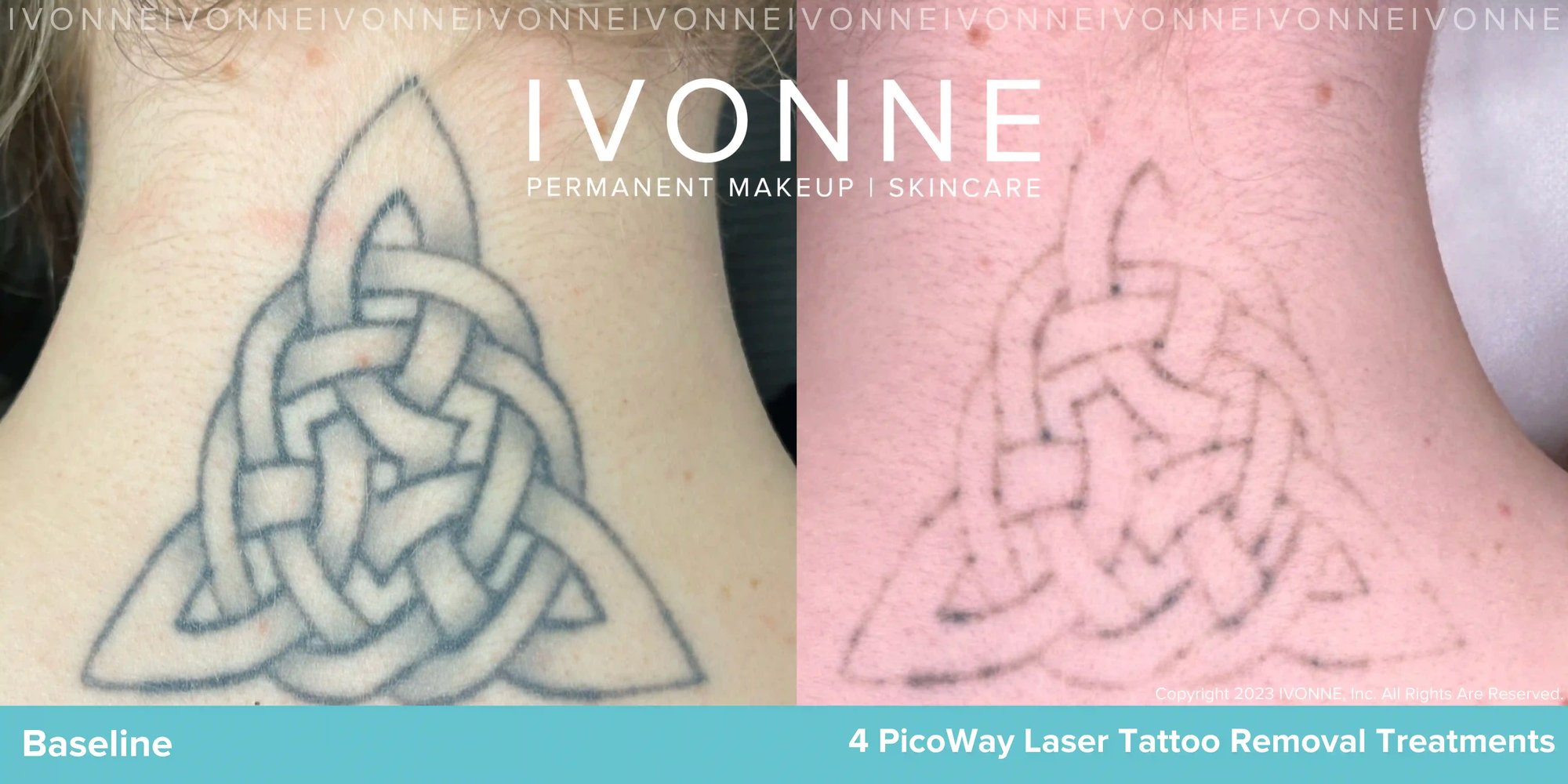 Laser Tattoo Removal Before After Results