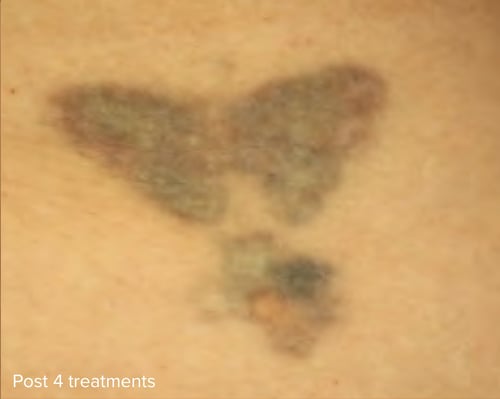 Laser Tattoo Removal Colour Post 4 Treatments