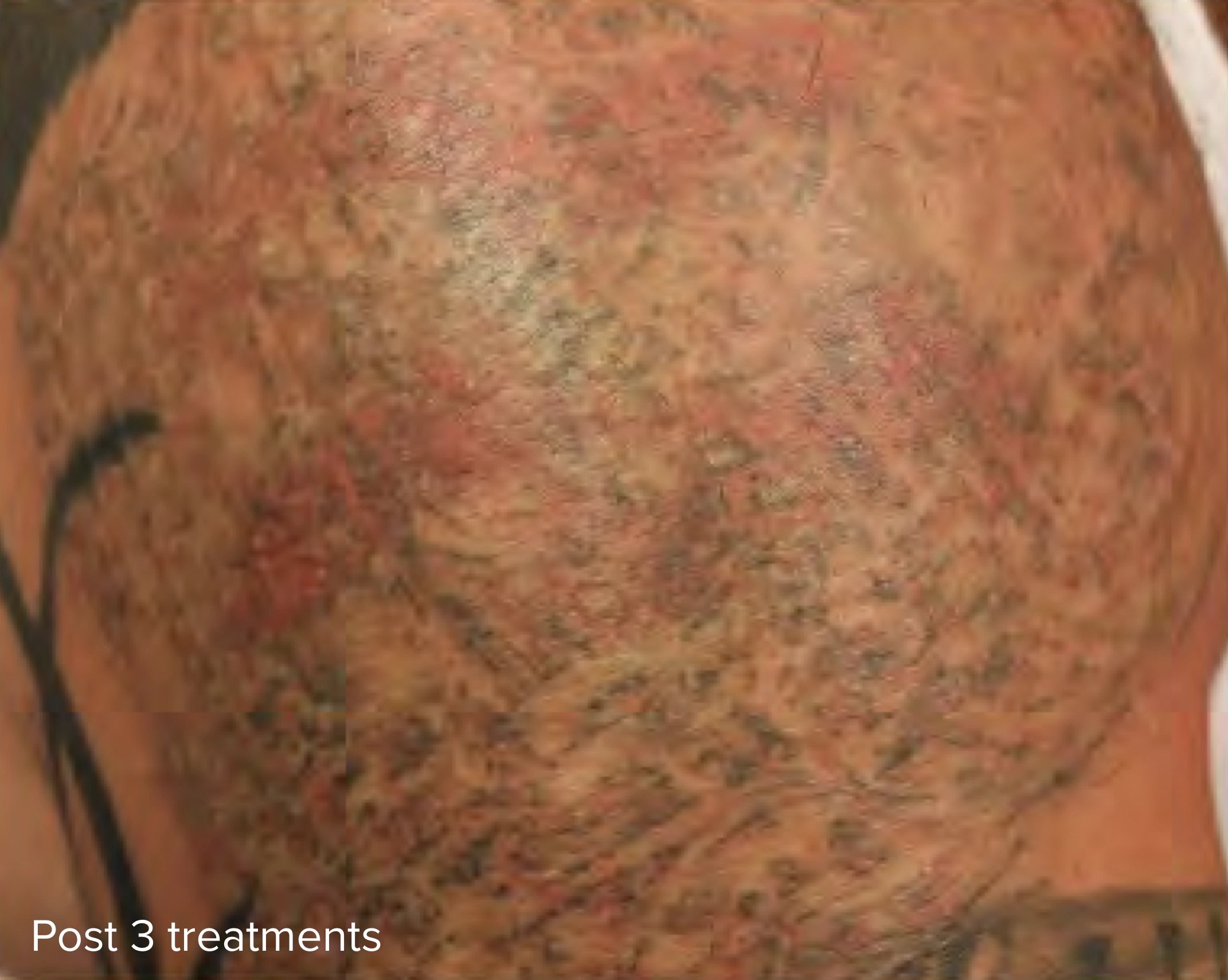 Laser_Tattoo_Removal_Post_3_Treatments