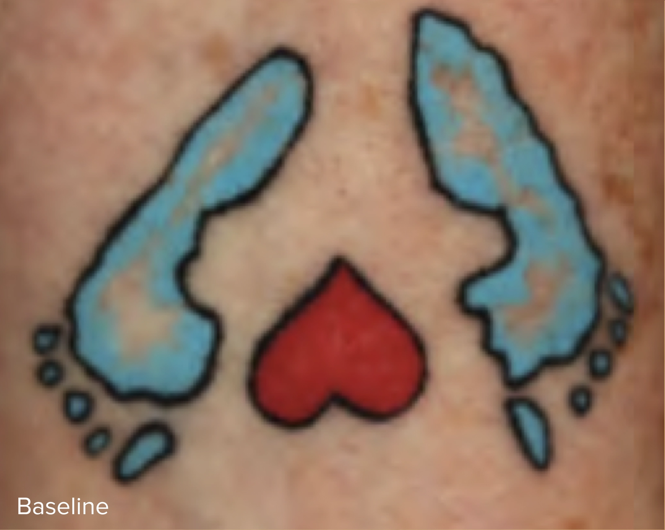 Colour Laser Tattoo Removal Baseline