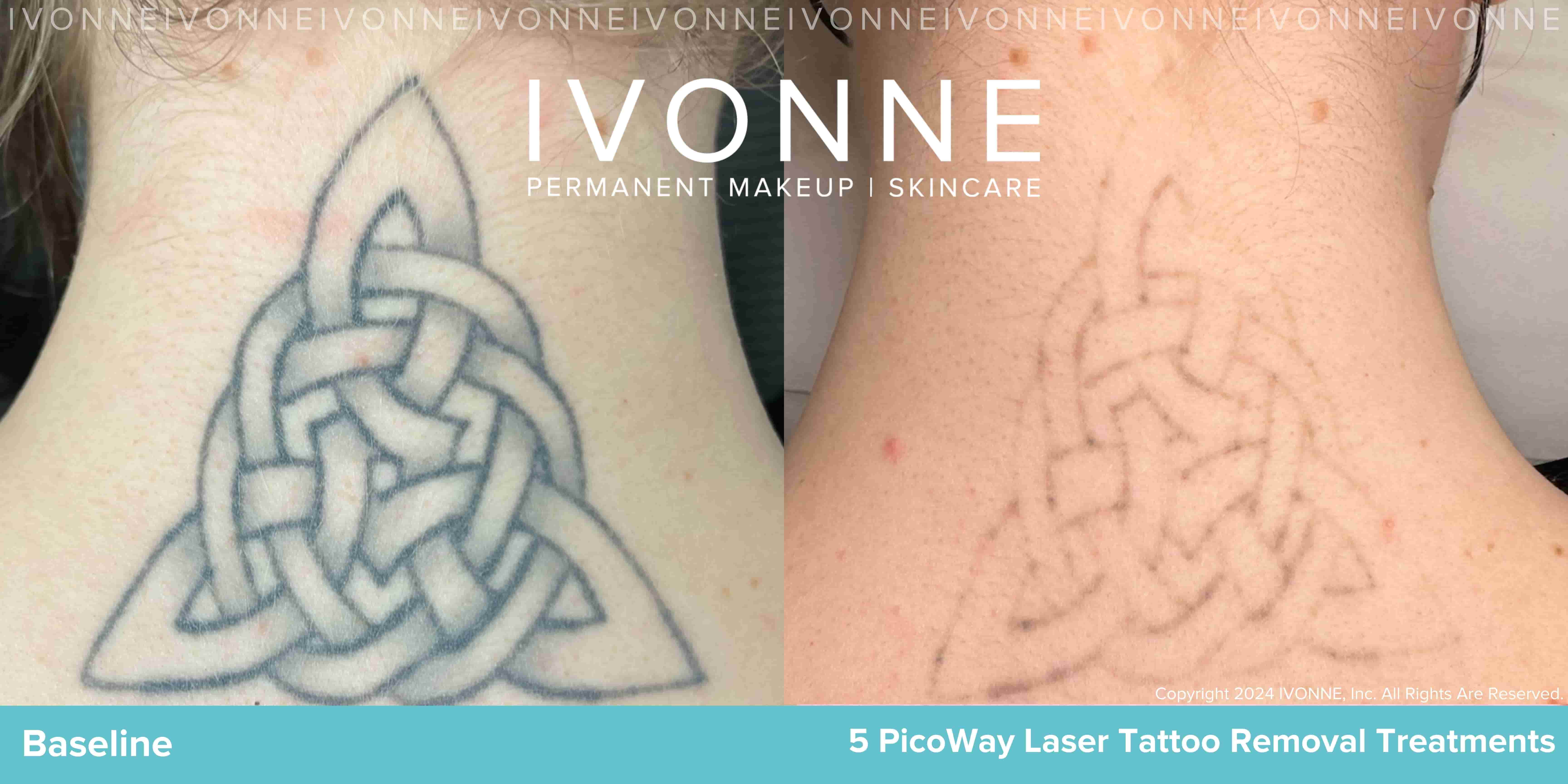 Tattoo Removing at best price in Pune | ID: 8006780662