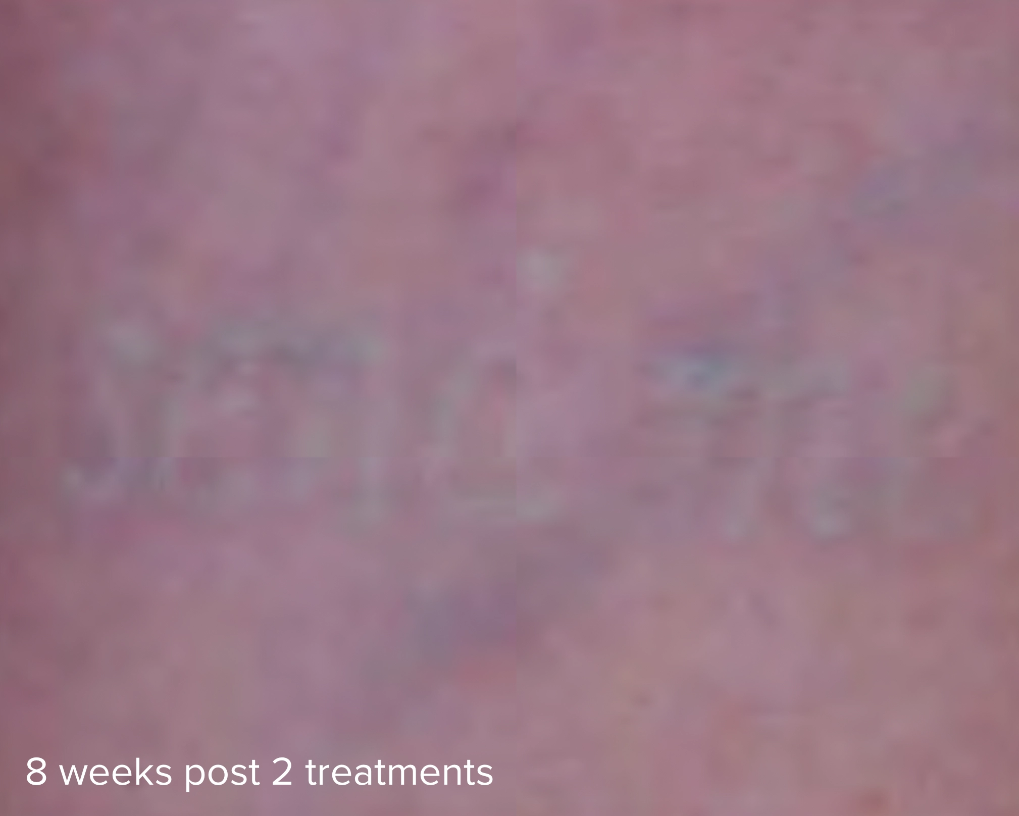 Laser Tattoo Removal 785 8 Week Post 2 Treatments