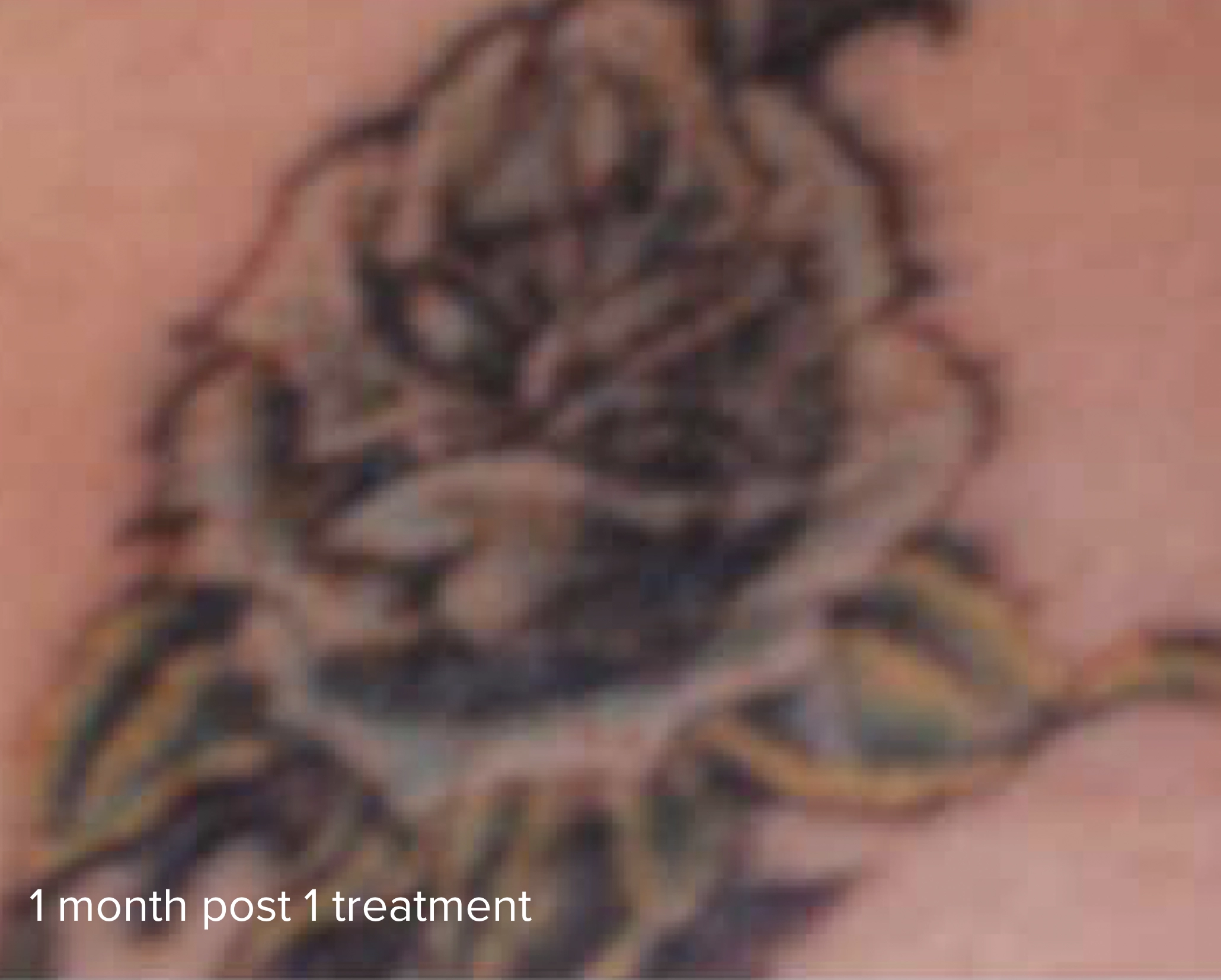 Laser Tattoo Removal 785nm 1 month post treatment