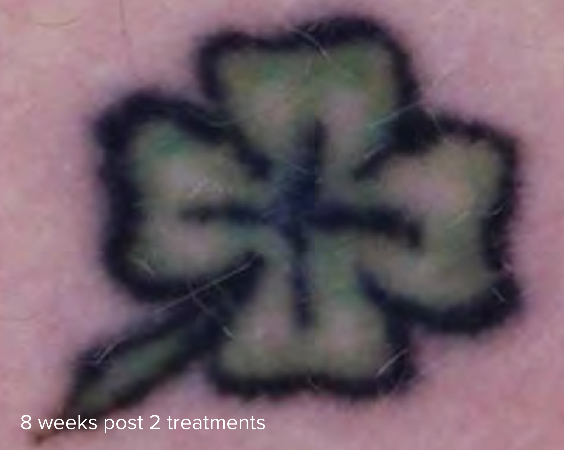 Laser Tattoo Removal 785nm 8 weeks post 2 treatments
