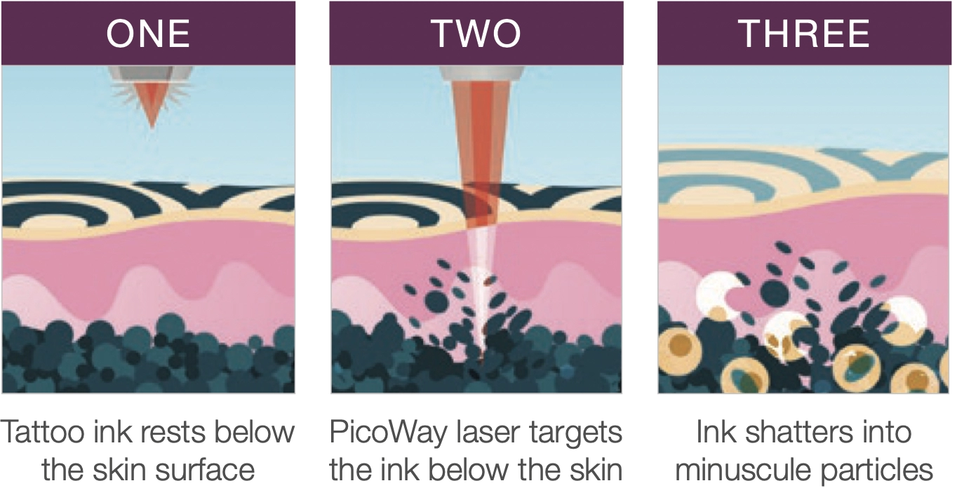 PicoWay Laser Steps