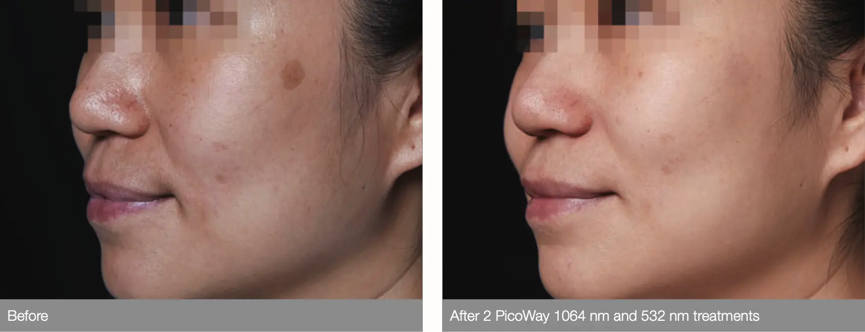 PicoWay_Resolve_Laser_Skincare_Treatments