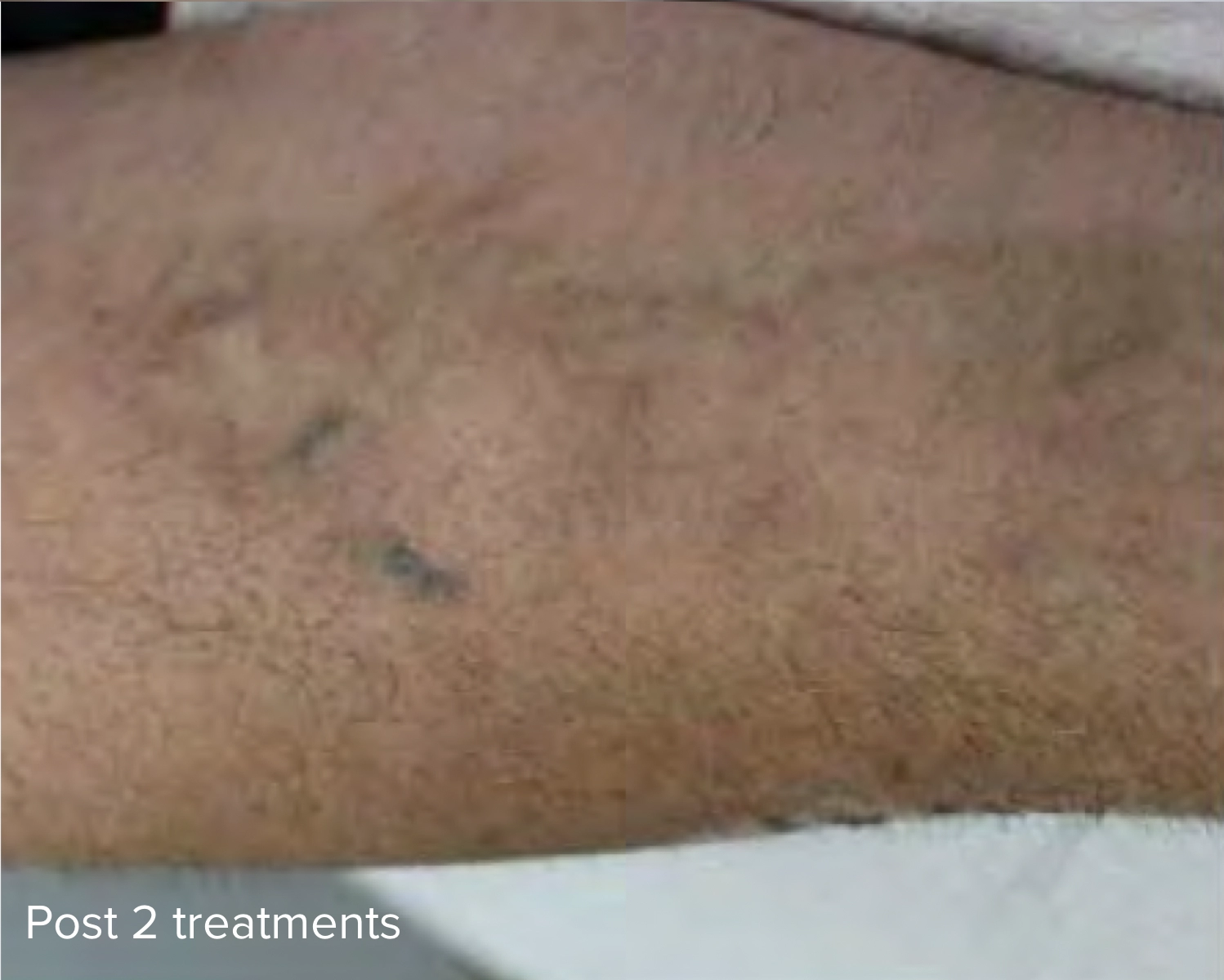 Post 2 Treatments Laser Tattoo Removal Treatment